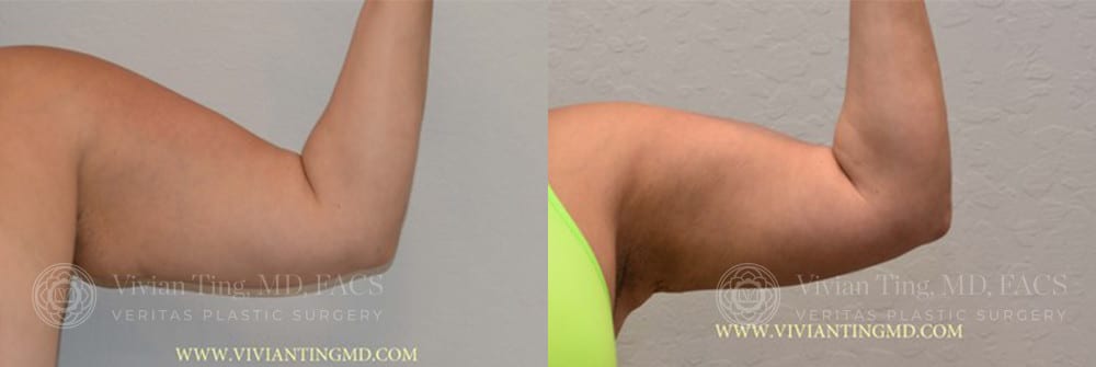 BodyTite Arms Before and After