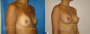 Female before augmentation