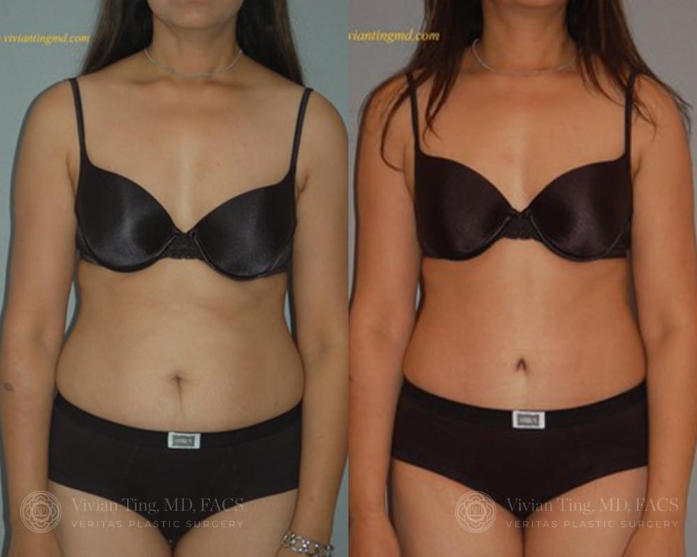 Tummy Tuck (abdominoplasty) Plastic Surgery Before And After
